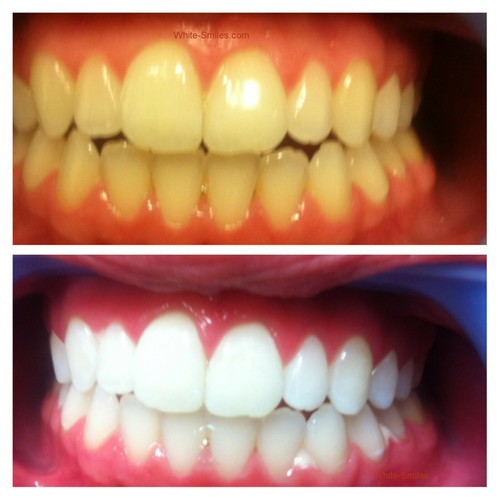 Very strong teeth - very,